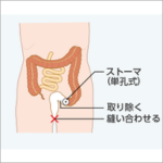 ストーマ造設を行う疾患と術式 :ストーマについての基礎知識