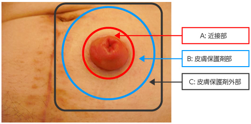 図1　ストーマ周囲皮膚の区分(ABCD-Stoma®による)